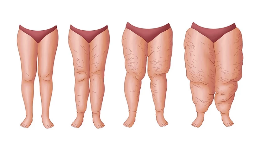 Lipodem